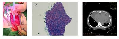 Case report: A case of primary cardiac malignant mesothelioma